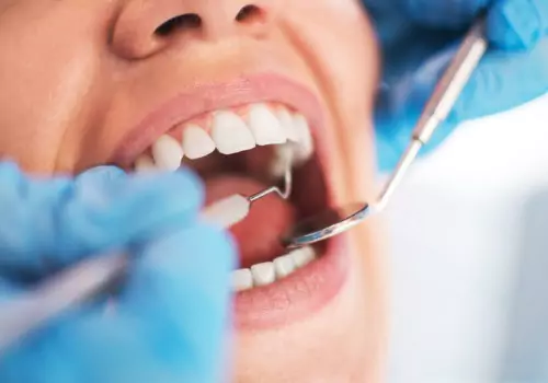 A woman under sedation having her teeth cleaned as part of Sedation Dentistry in Lincoln IL