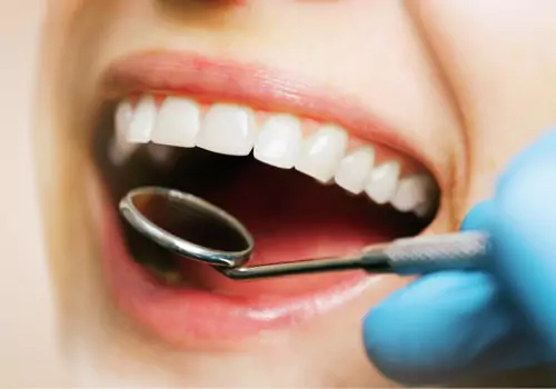A dental exam is seen. Total Dental Care offers Teeth Whitening in Peoria IL.