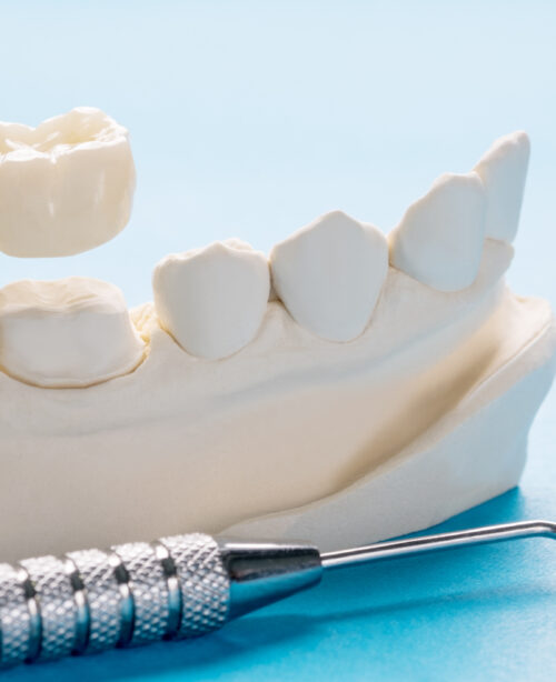 Dental Crowns